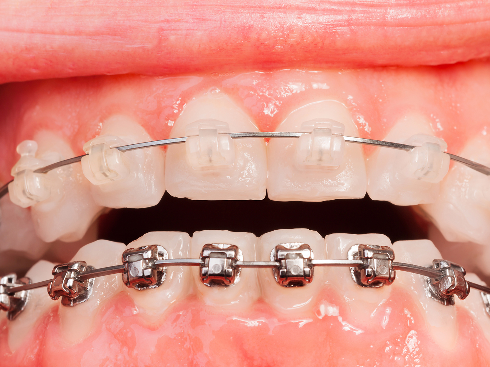 Braces for Teeth in Mulund West