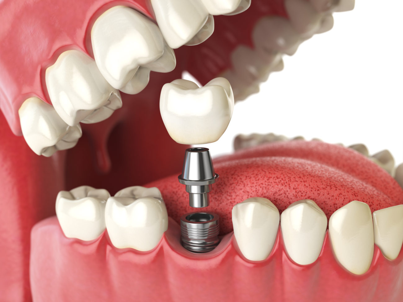  Implant Supported Dentures in Mumbai 