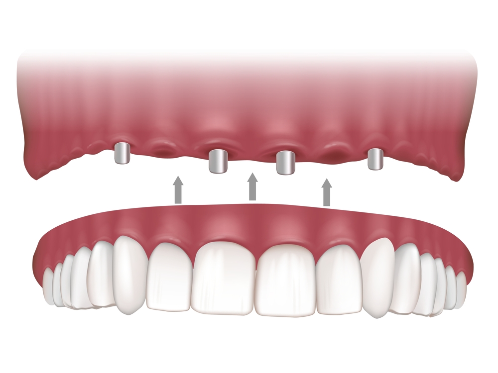 Implant Supported Dentures & Fixed Teeth in Mulund West 