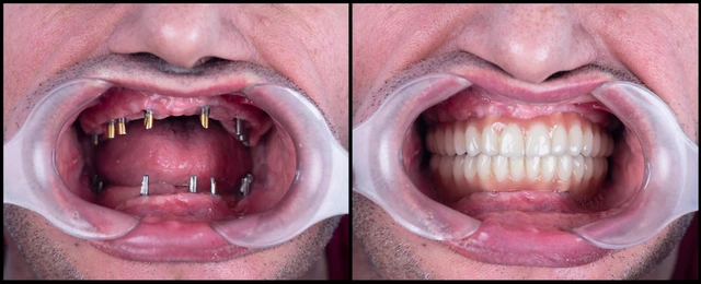 Best Full Mouth Dental Implant Surgeon in Mumbai