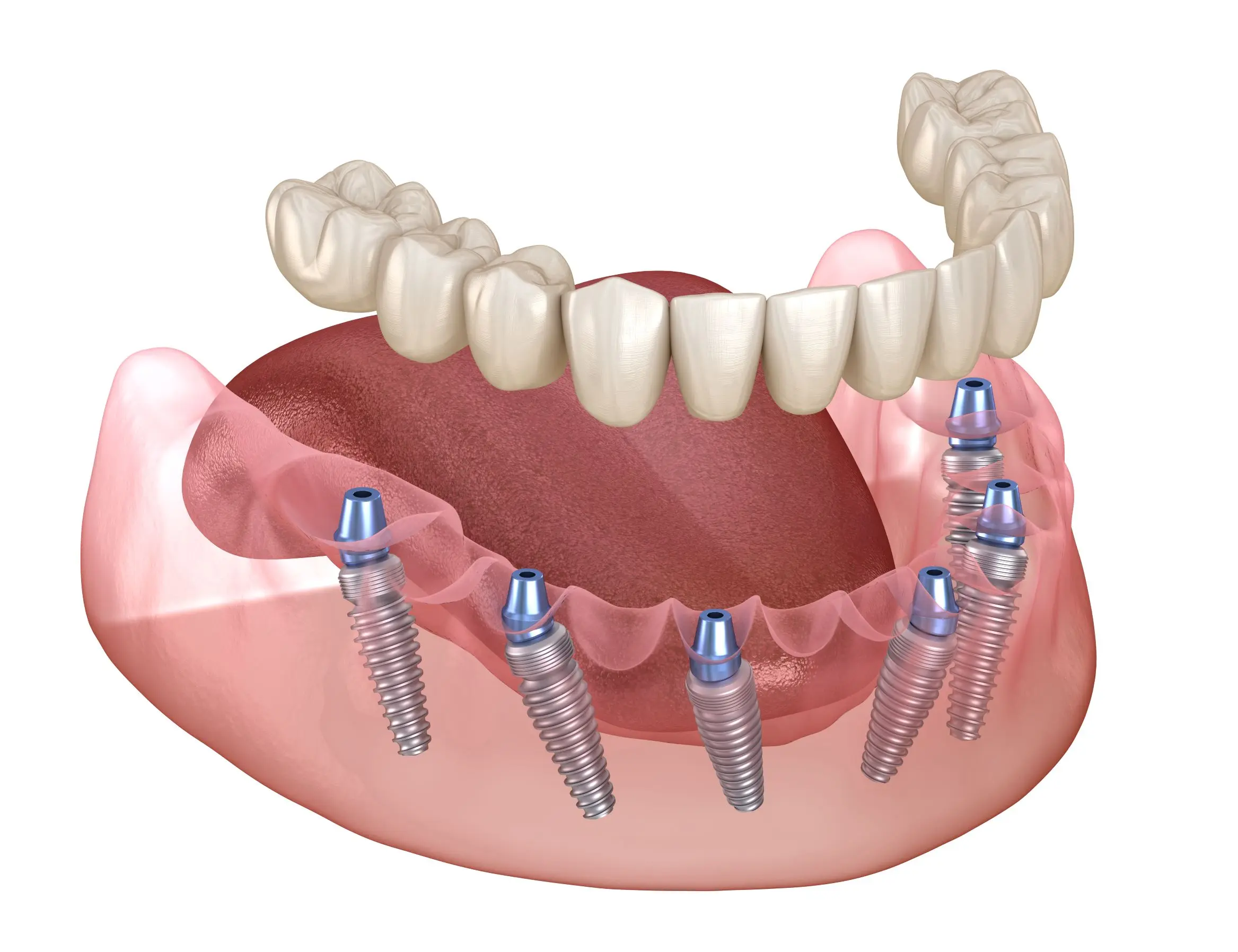 Best Full Mouth Dental Implant Surgeon in Mulund, Mumbai