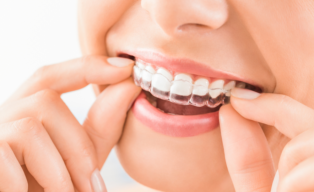Best Invisalign Teeth Aligners Doctor in Mulund West 
