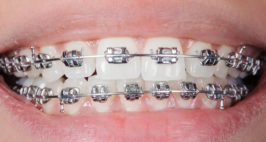 Best Invisible Metal and Ceramic Braces for Teeth in Mulund