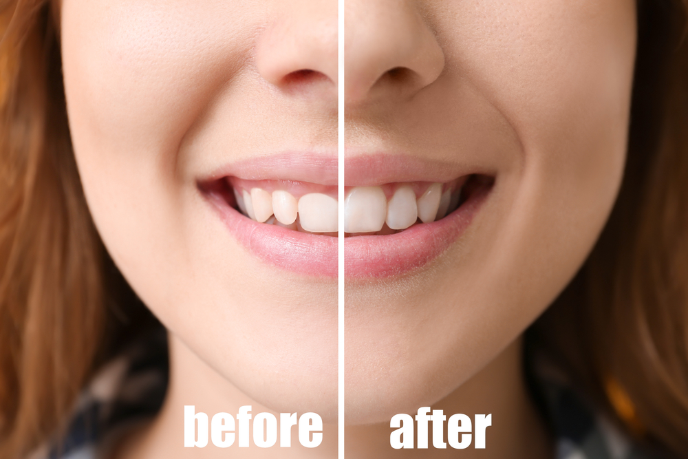 Best Dental Scaling and polishing in Mulund West