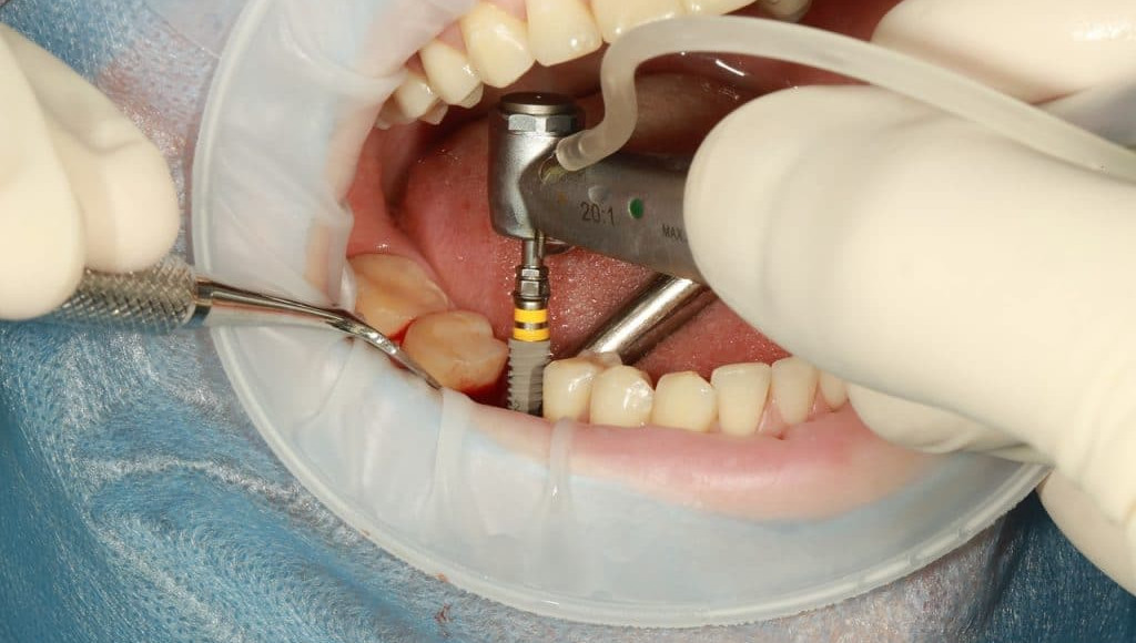 Single Tooth Dental Implants in Mulund West