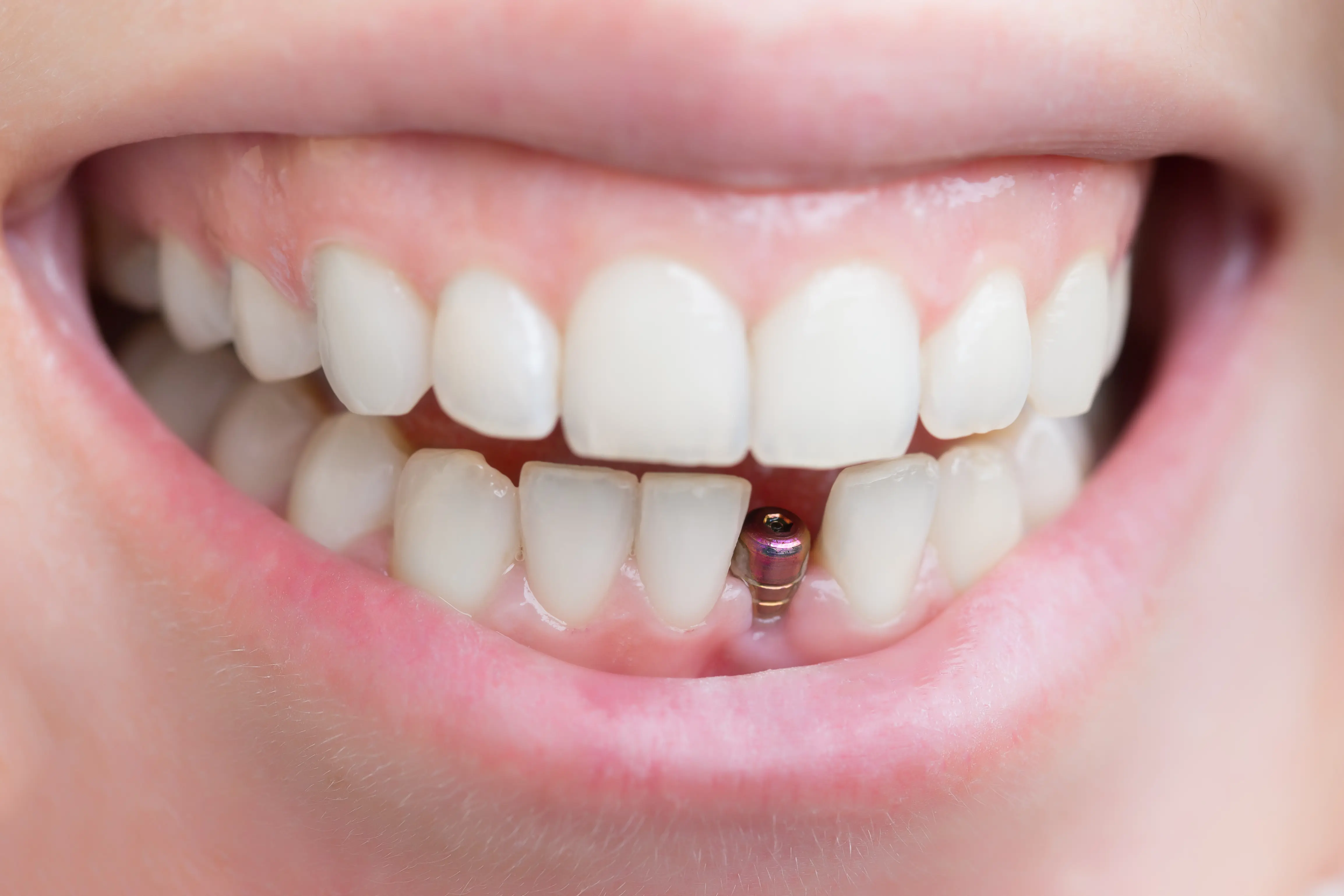 Single Tooth Dental Implants in Mulund West, Mumbai