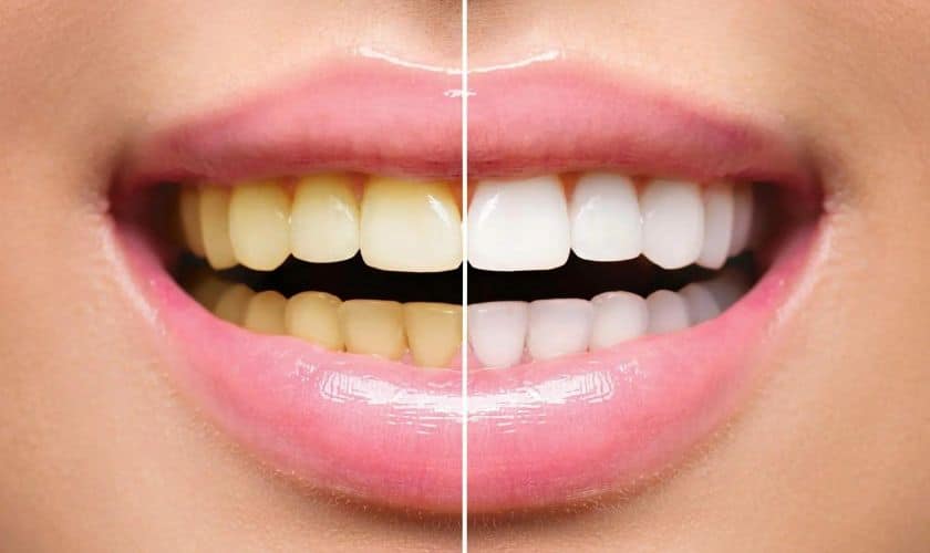 Best Teeth Whitening Treatment in Mulund
