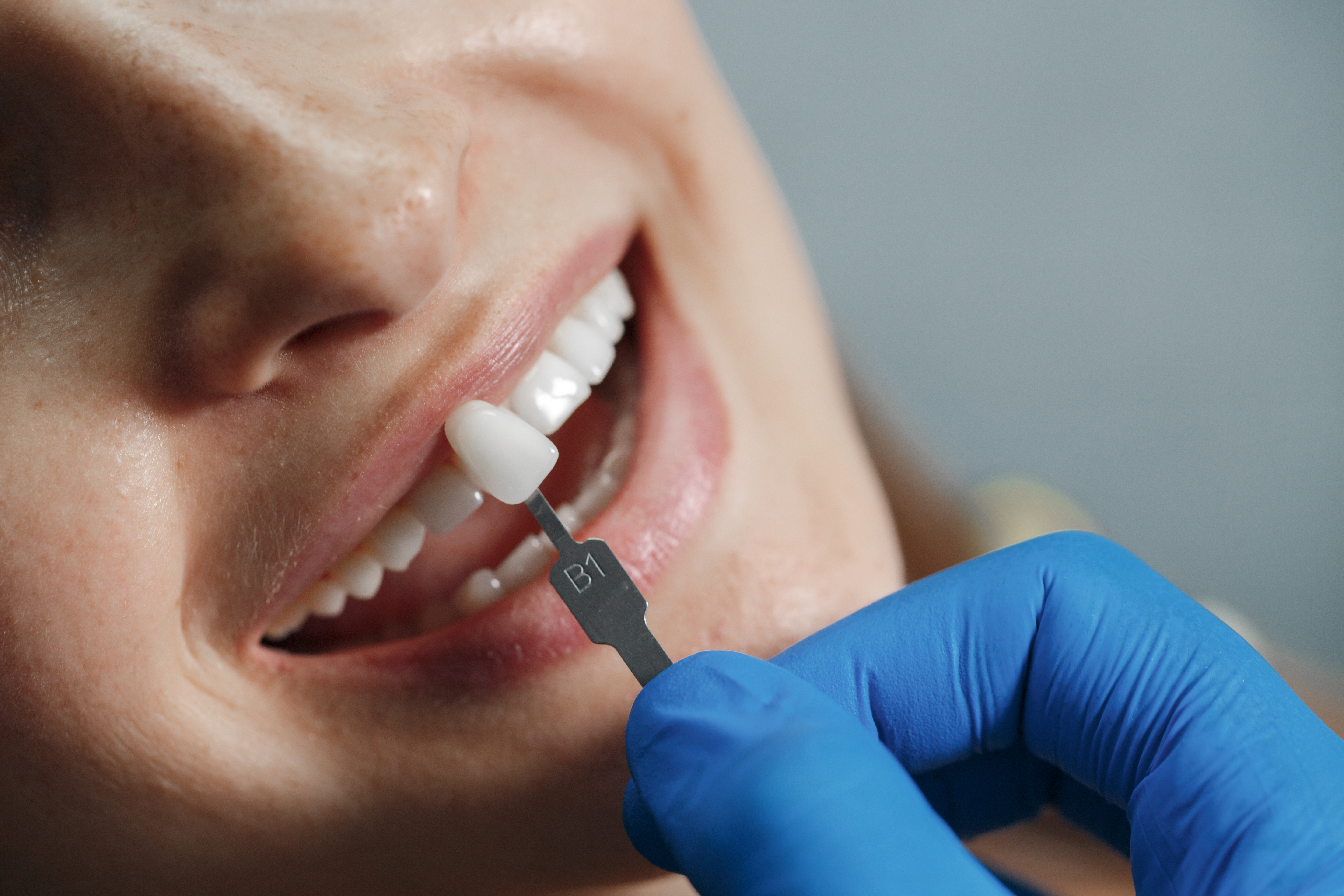 Best Dental Veneer Treatment in Mulund West