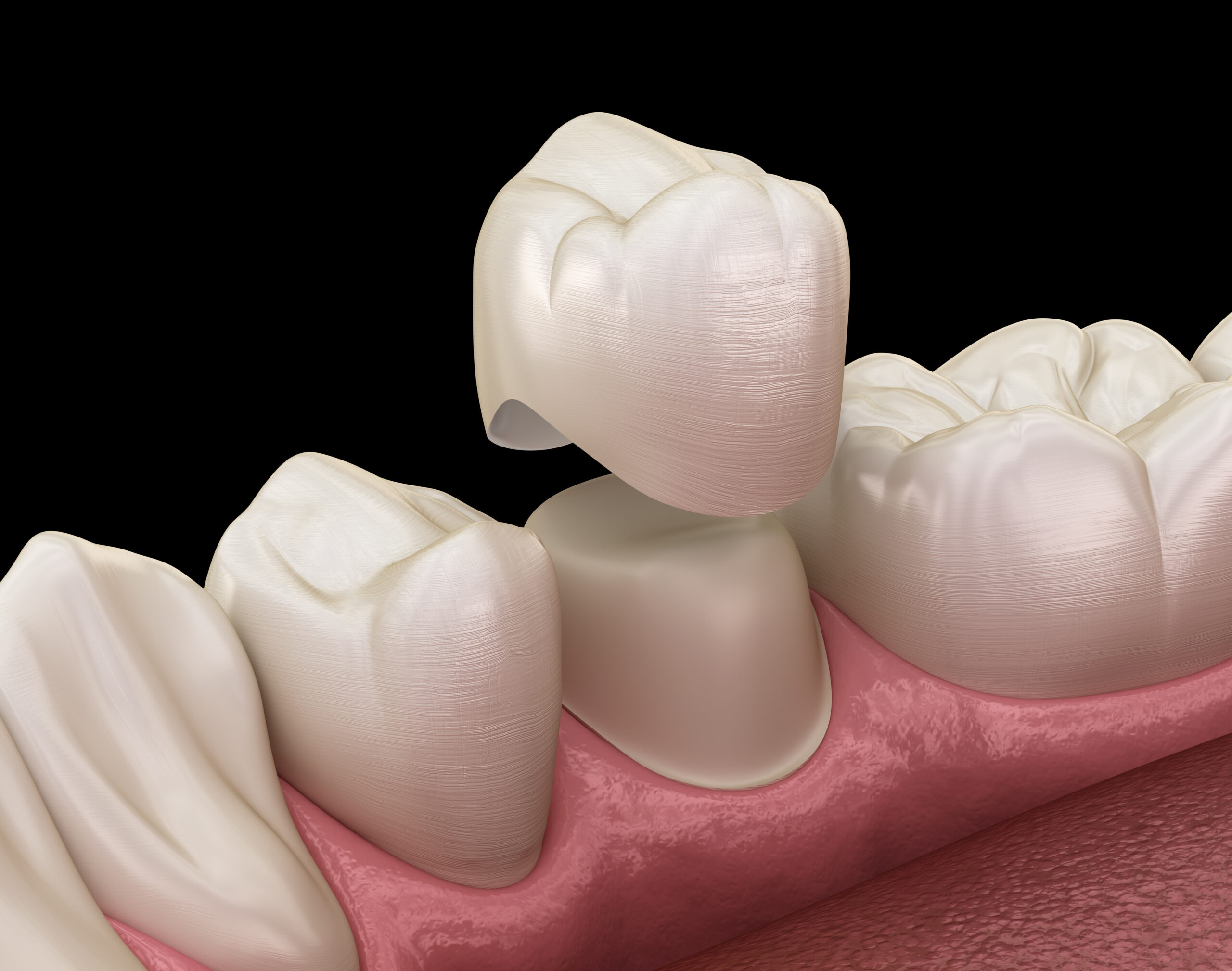 Best Dental Veneer Treatment in Mulund West 